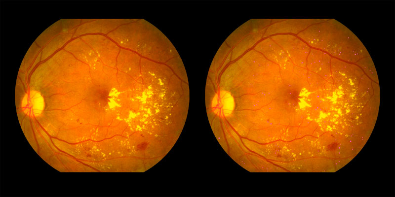 Two photos of human eye scan where signs of microaneurysms identified by AIRA are shown in pink dots