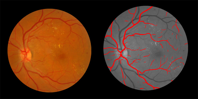 Two photos of human eye scan where arteries identified by AIRA are shown in red