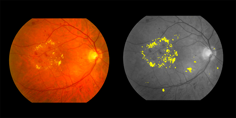 Two photos of human eye scan where exudates identified by AIRA are shown in yellow