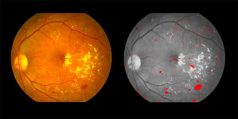Two photos of human eye scan where haemorrhages identified by AIRA are shown in red