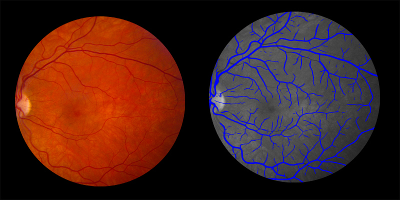 Two photos of human eye scan where veins identified by AIRA are shown in blue