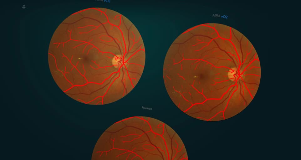 Blood vessels of a human eye detected by AIRA app